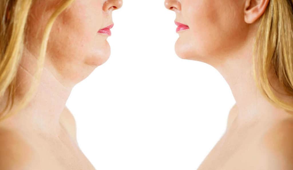 Double Chin treatment Salisbury before and after results