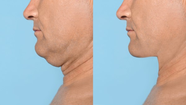 Which Non-Surgical Treatments Work Best for Jowls and Loose Skin Salisbury?