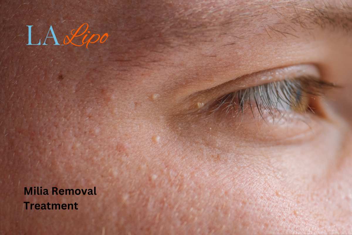 Milia Removal Service Salisbury