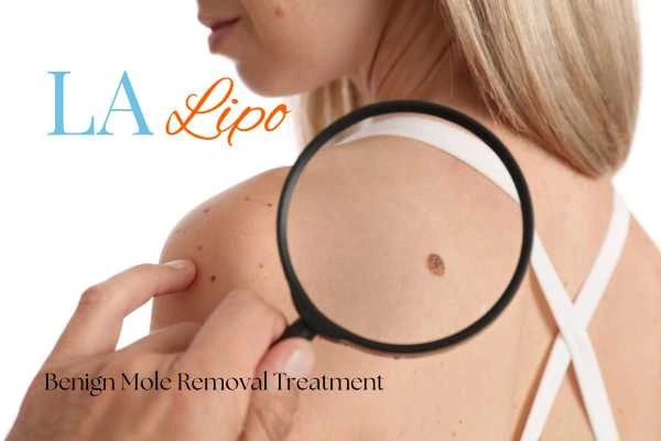 Woman having her inspection of blemish before mole removal Salisbury