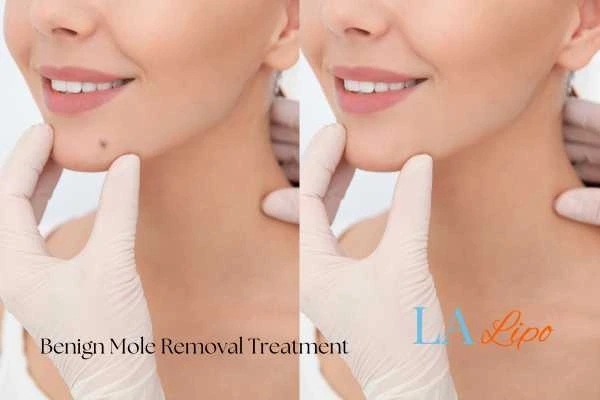 woman's before and after mole removal Salisbury results