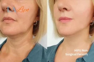 hi-fu for wrinkles Salisbury before and after results