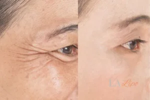 Before and after results of woman - HI-fu wrinkles reduction treatment Salisbury