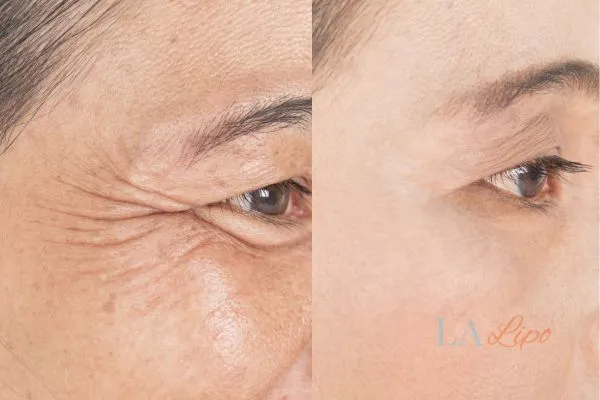 Before and after results of woman - HI-fu wrinkles reduction treatment Salisbury