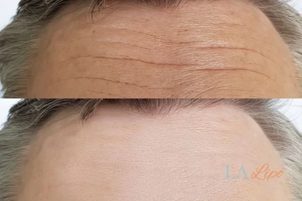results of HIFU Salisbury on mans forehead to help reduce lines and wrinkles