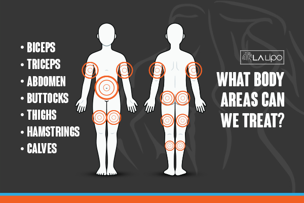 Graphic to show areas you can have LA-EMS Body Sculpting Salisbury treatment.