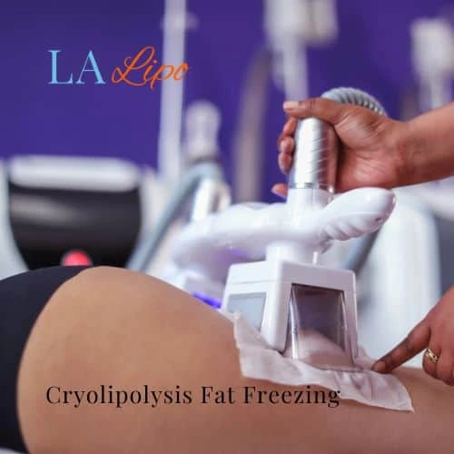 fat freezing - Cryolipolysis Salisbury