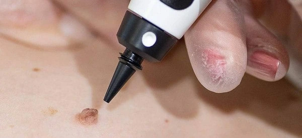 skin tag removal using cryopen Salisbury