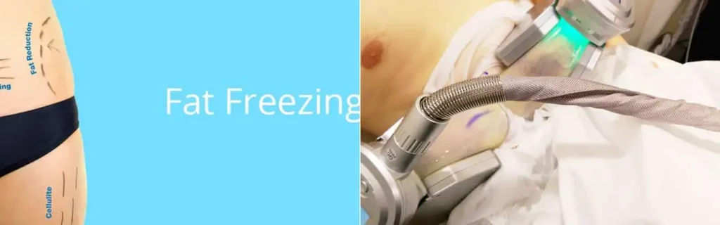 multi areas of a persons body having coolsculpting Salisbury treatment