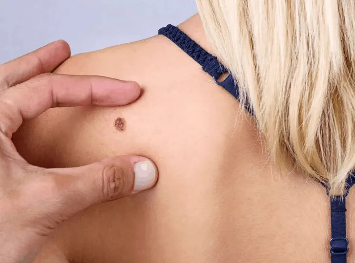 woman having mole removal Salisbury consultation before treatment.