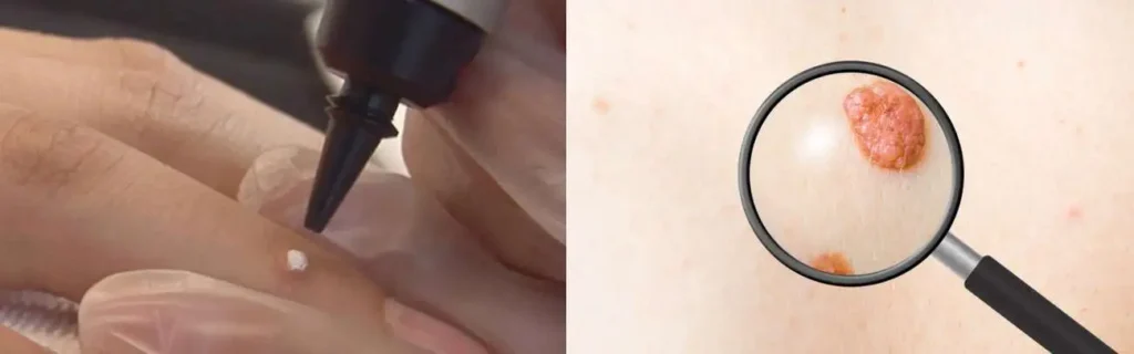Cryopen for mole removal Salisbury - speak to our team today!