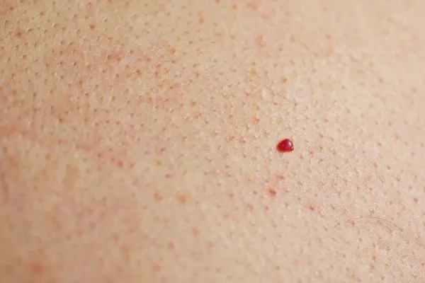 close up of a cherry angioma Salisbury