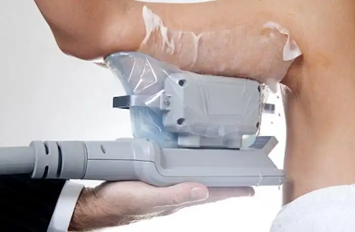 Picture of fat freezing Salisbury on the upper arms.