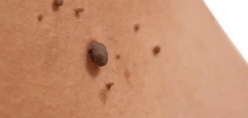 image of a skin tag Salisbury