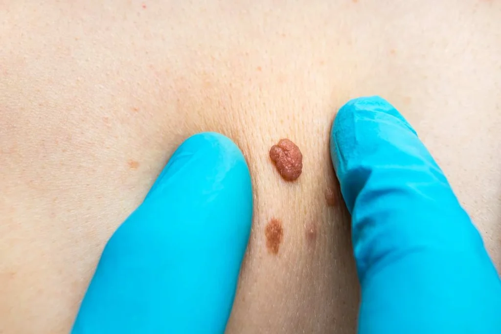 Consultant examining a skin tag Salisbury