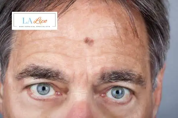 Solar Lentigo Removal Salisbury image of man with mark on his forehead