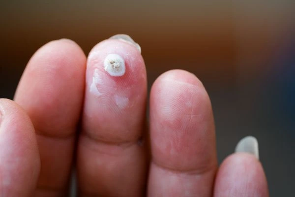 wart on person finger - cryotherapy to treat from LA LIPO Salisbury