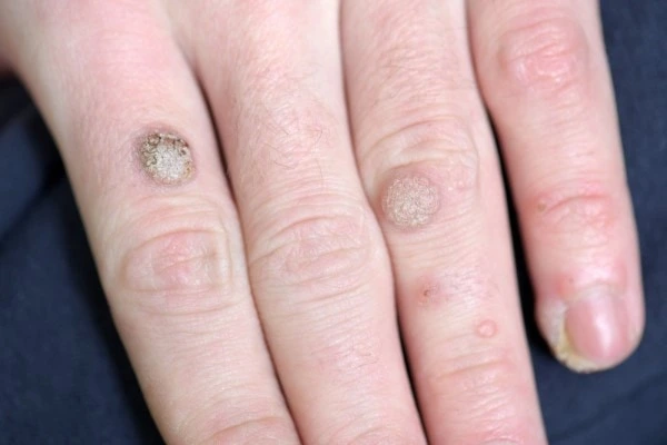 photo of warts on person hand - see wart removal Salisbury from LA LIPO