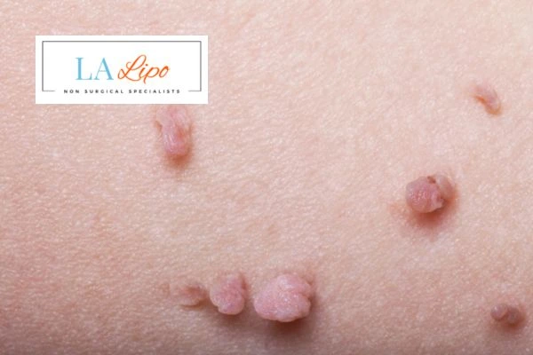 Does cryopen skin tag removal Salisbury hurt? Find out now call our team today!