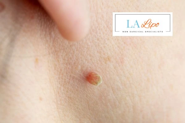 Book skin tag removal Salisbury today speak to our team now!