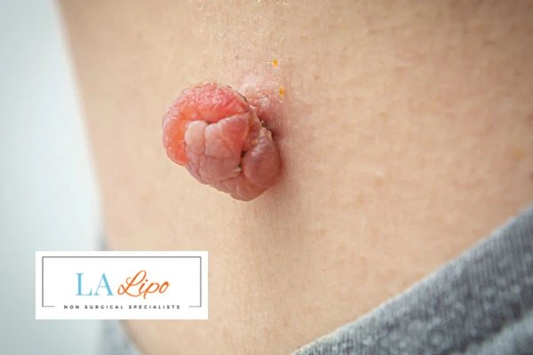 Interested in skin tag removal Salisbury? Concerned about the pain? Find out more today!