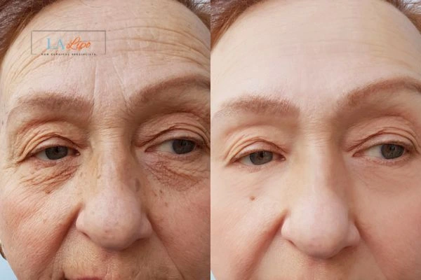 The powerful benefits of Morpheus8 Treatment Salisbury - Call Our team today!