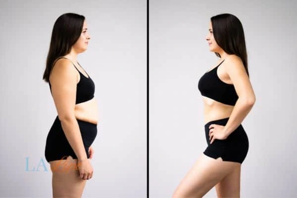 Picture of womans before and after using LA-EMS body sculpting to improve her core strength Salisbury