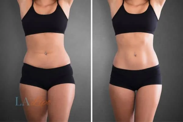 before and after results of non-surgical treatment to help a woman's body image and mental health Salisbury