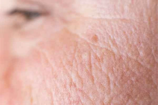 close up picture of a woman's face showing an age spot Salisbury