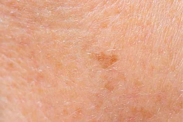 close up picture of age spots Salisbury