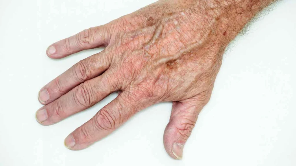 Male hand showing age spot Salisbury