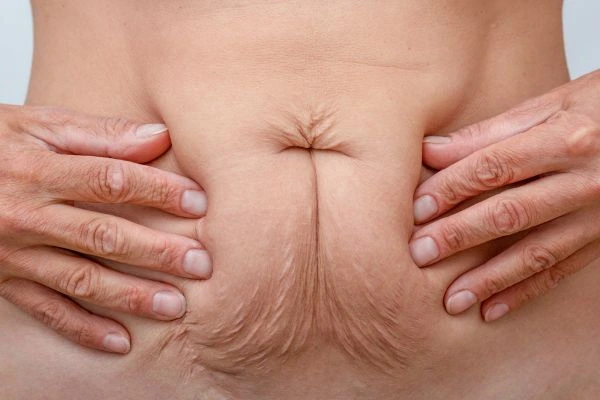 Image of a woman's stomach with loose skin - example of skin tightening Salisbury options
