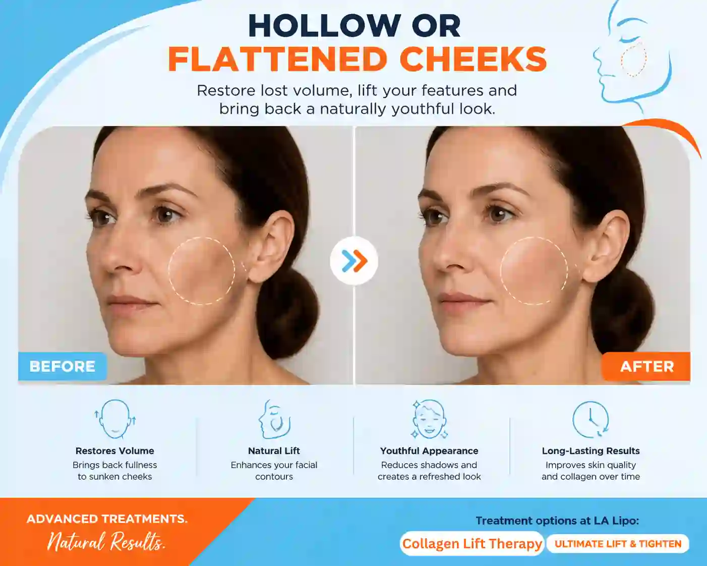 Sign #4: Hollow or Flattened Cheeks Salisbury