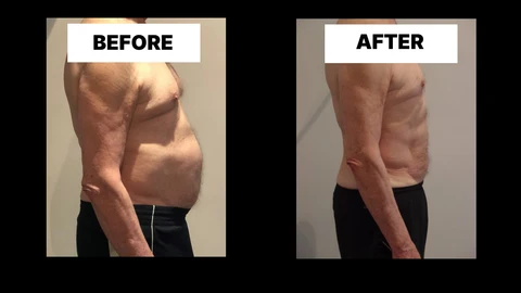 What Symptoms Can Diastasis Recti Cause in Men? Weak Core, Back Pain and Poor Posture Salisbury